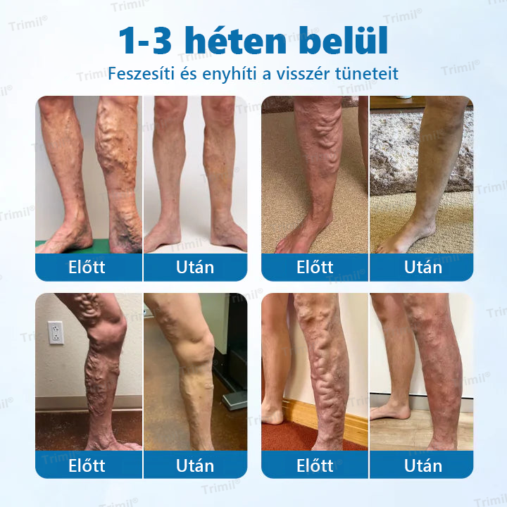 đTrimilÂź VeinGuard GyĂłgynövĂ©nyes Spray - â
Klinikailag bizonyĂtott, hogy mindössze 7 nap alatt megszĂŒnteti a visszereket!