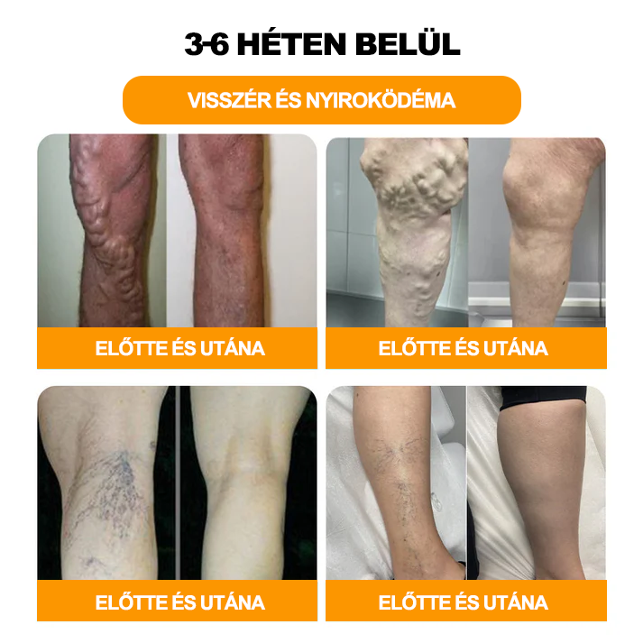 👑Purefeet™ Méhméreg Nyirokelvezető és karcsúsító lábfürdő gyöngyök - Minden nyirokproblémára és elhízásra alkalmas -CE tanúsítvánnyal